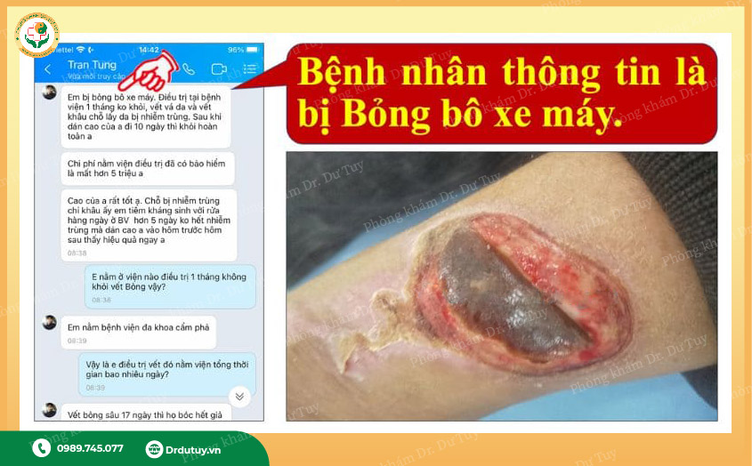 chữa lành vết bỏng bằng đông y