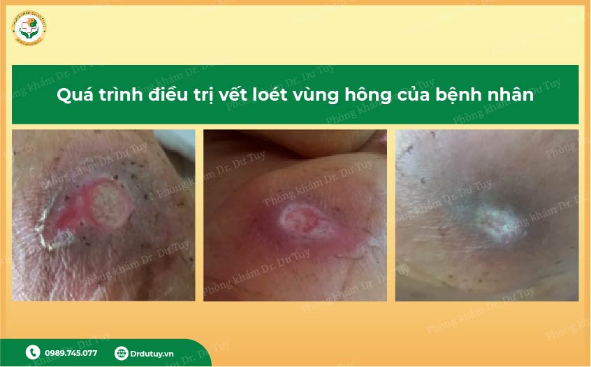 chữa loét da người cao tuổi