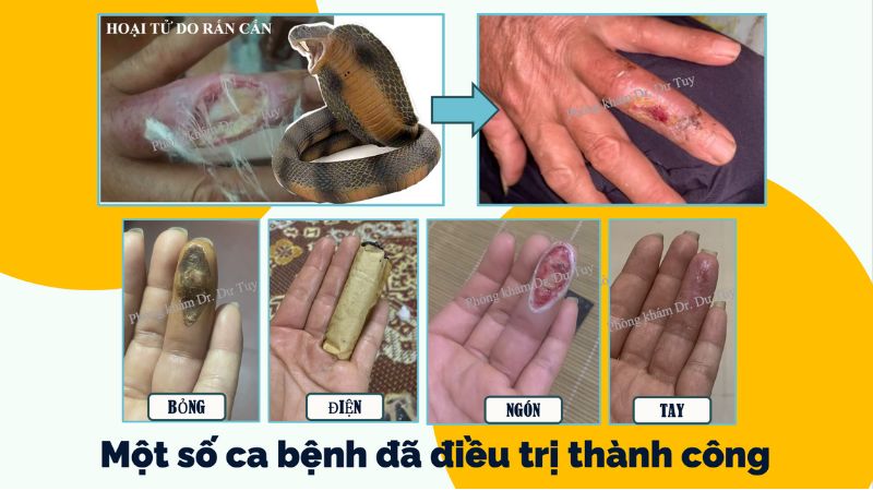 chữa vết thương hở