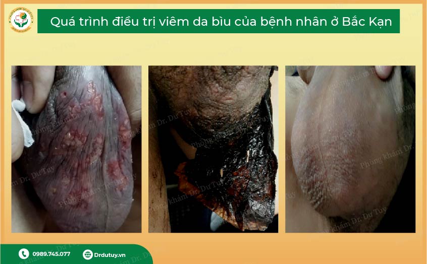 chữa viêm da bìu