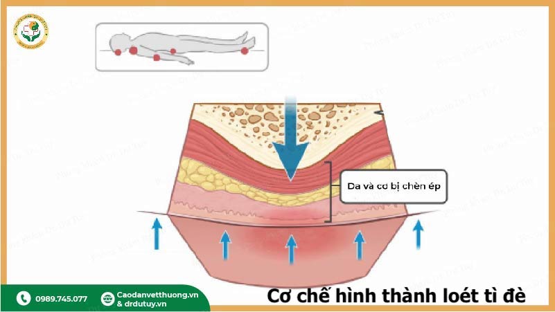 cơ chế hình thành loét tì đè