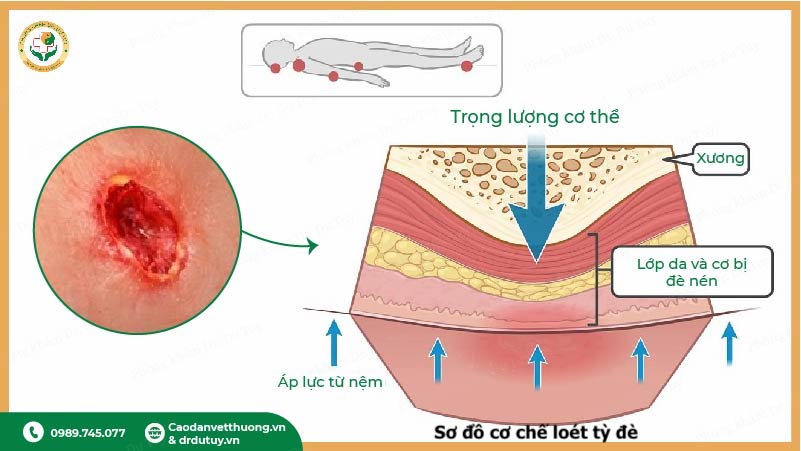 cơ chế hình thành loét tỳ đè