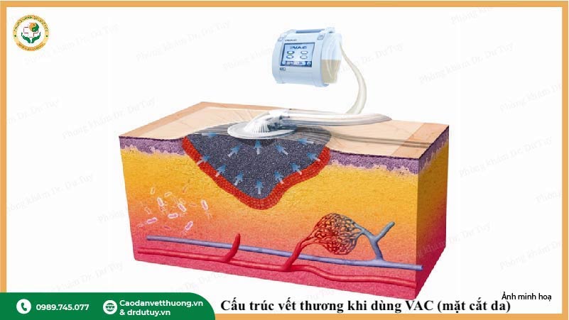 cơ chế hoạt động của VAC trong điều trị vết thương