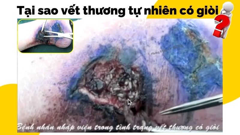 cơ chế sinh gòi myiasis theo y học