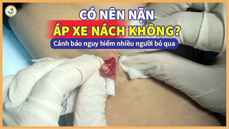 Có nên nặn áp xe nách không? Cảnh báo nguy hiểm nhiều người bỏ qua