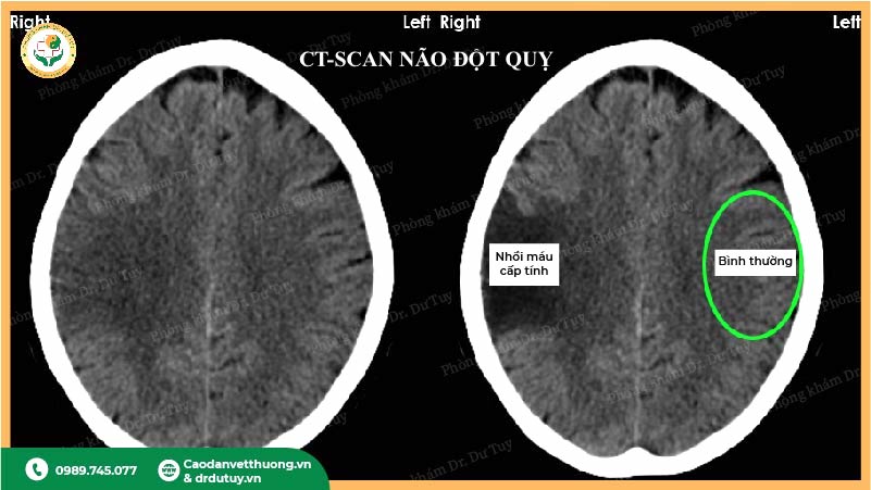CT- Scan não đột quỵ