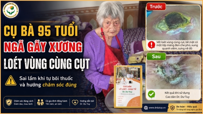 Cụ bà 95 tuổi bị ngã gãy xương nằm lâu: Vết loét vùng cùng cụt và bài học cảnh tỉnh cho mọi gia đình