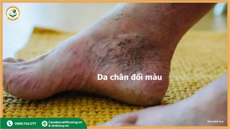 da chân đổi màu do biến chứng tiểu đường
