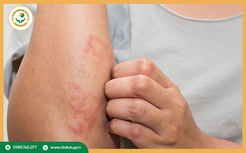 Da đau rát như bị bỏng là làm sao? Cách xử lý hiệu quả