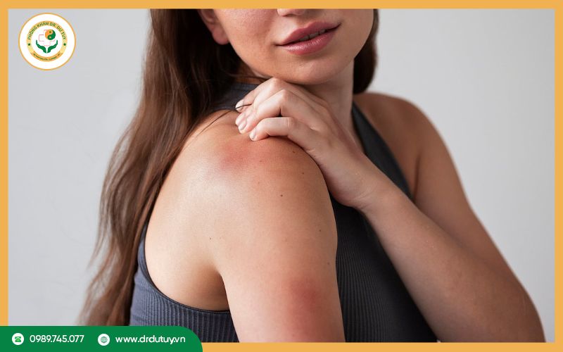 Triệu chứng da đau rát như bị bỏng