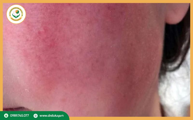 Cách xử lý da đau rát như bị bỏng