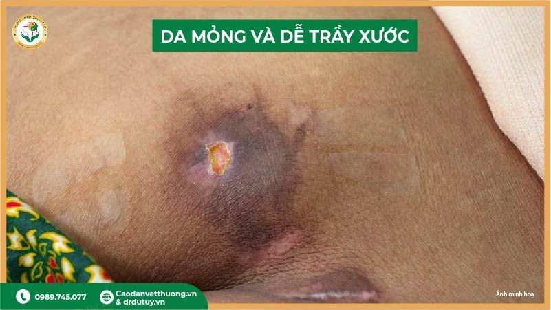 da mỏng và dễ trầy xước ở vùng cùng cụt