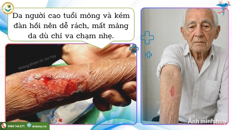 da người cao tuổi mỏng dễ bị rách