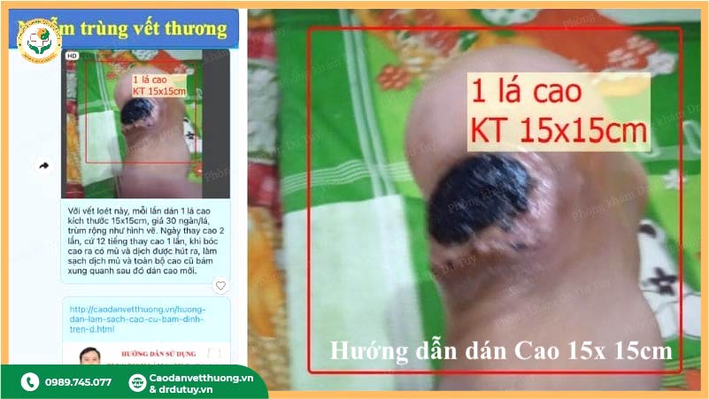 dán cao 15x 15cm vết thương gót chân