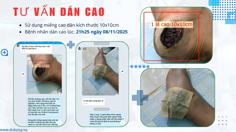 dán cao lở loét hoại tử 10x 10cm