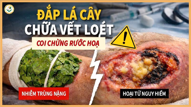 Đắp lá cây chữa vết loét – Coi chừng rước họa