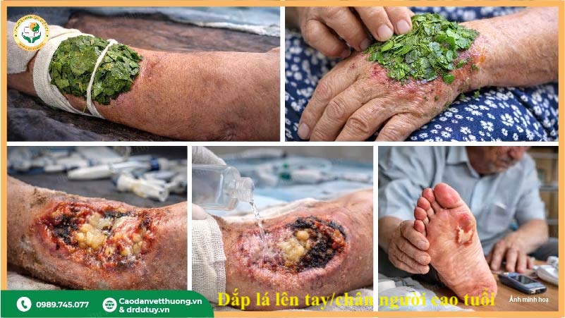đắp lá thuốc nam lên vết thương hở