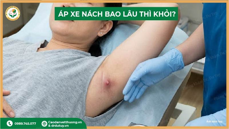 dấu hiệu áp xe nách sắp vỡ
