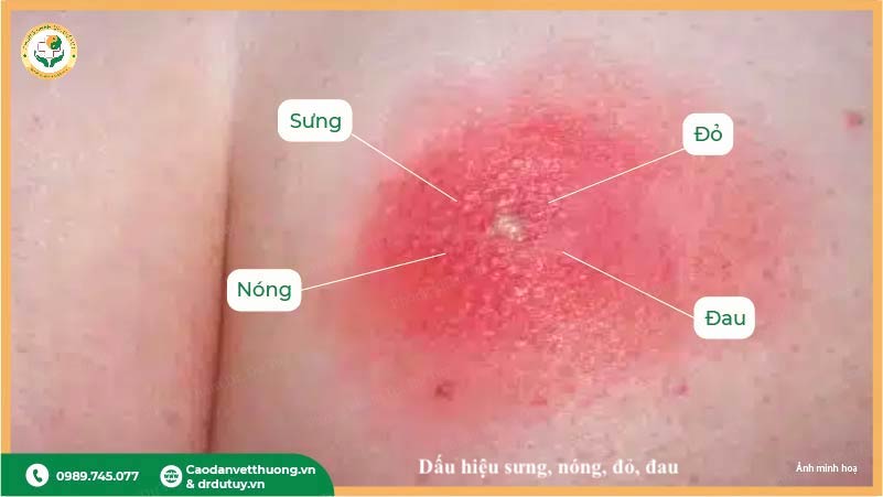 dấu hiệu áp xe sau tiêm sưng nóng đỏ đau