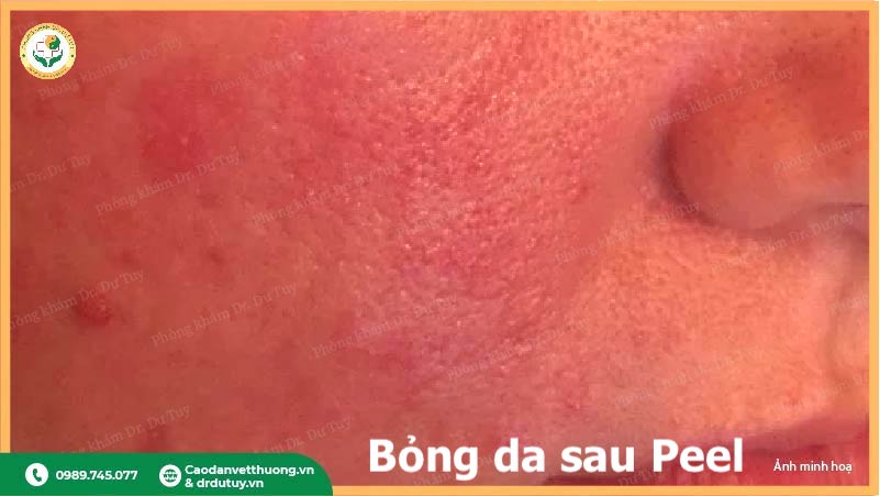 dấu hiệu bỏng da sau peel đỏ rát kích ứng