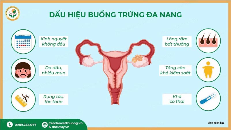 dấu hiệu buồng trứng đa nang pcos