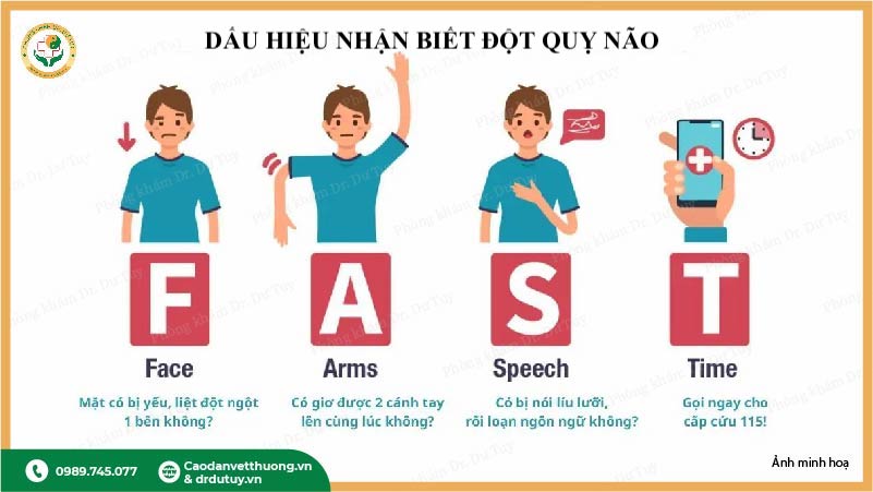 dấu hiệu fast đột quỵ