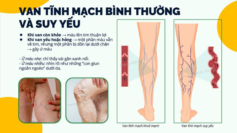 dấu hiệu giãn tĩnh mạch