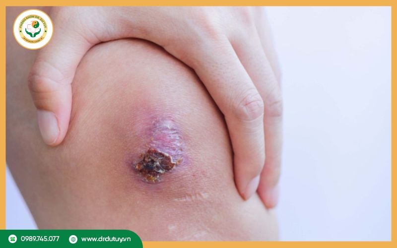 Dấu hiệu hoại tử da và phương pháp điều trị