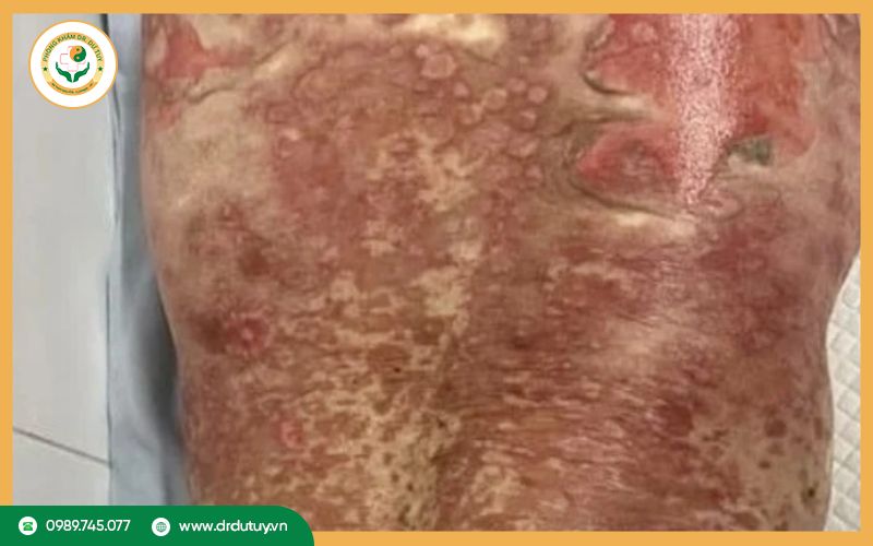 Hoại tử da là gì?