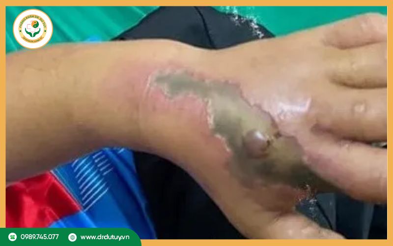 Phần da bị hoại tử sưng, cứng gây đau nhức