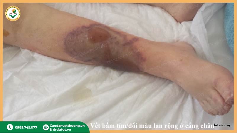 dấu hiệu hoại tử da tím xám đổi màu