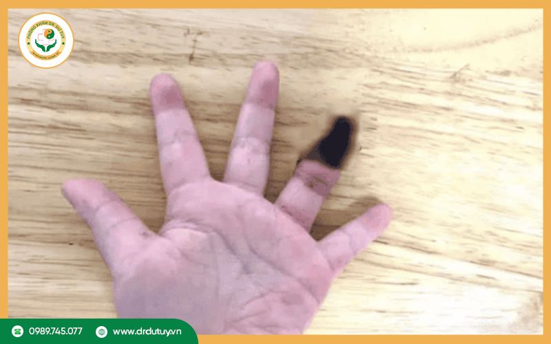 Một số dấu hiệu hoại tử khô thường gặp