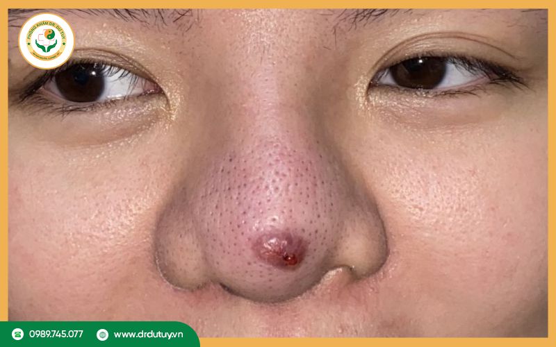 Dấu hiệu hoại tử mũi cần biết để tránh rủi ro mất mô mũi