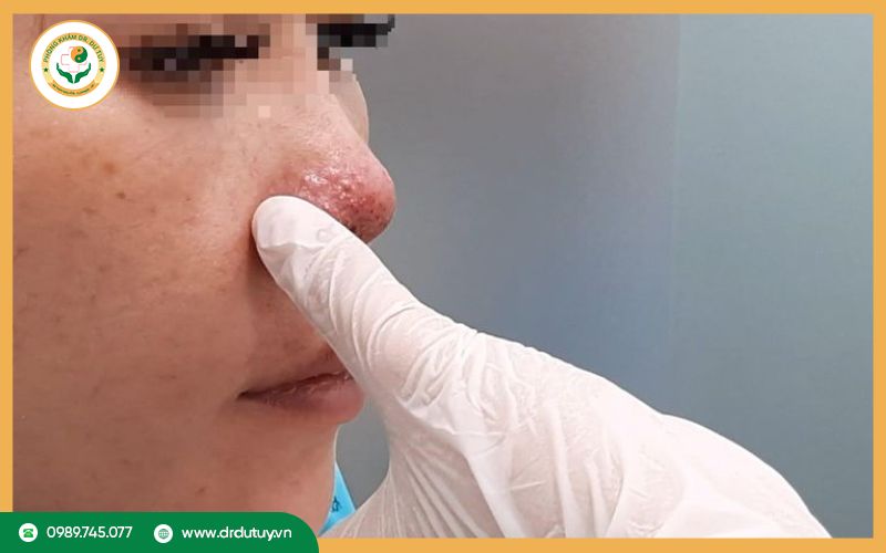 Đối tượng có nguy cơ bị hoại tử mũi