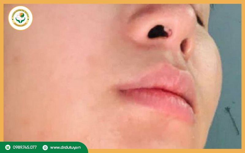 Cách điều trị hoại tử mũi
