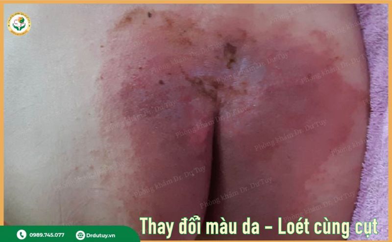 dấu hiệu loét da ban đầu