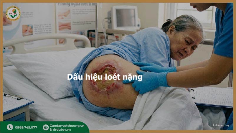 dấu hiệu loét tì đè nặng ở người nằm lâu