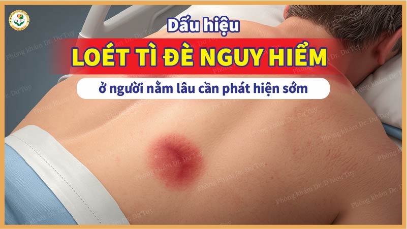 Dấu hiệu loét tì đè nguy hiểm ở người nằm lâu cần phát hiện sớm