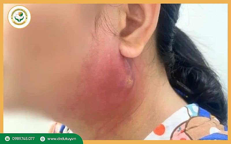 Dấu hiệu mụn nhọt bị nhiễm trùng: Nhận biết sớm để điều trị an toàn