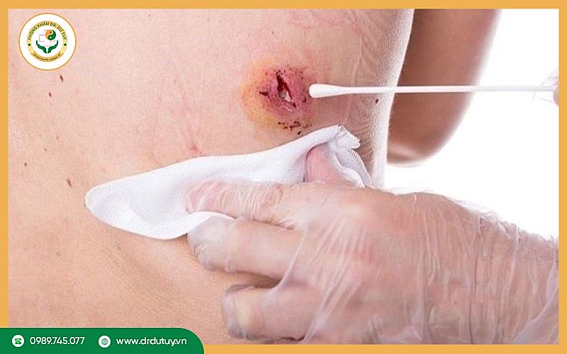 Cách trị mụn nhọt bị nhiễm trùng