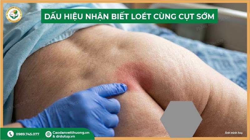 dấu hiệu nhận biết loét cùng cụt sớm