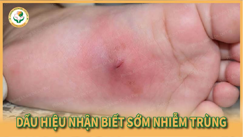 Dấu hiệu nhận biết sớm nhiễm trùng