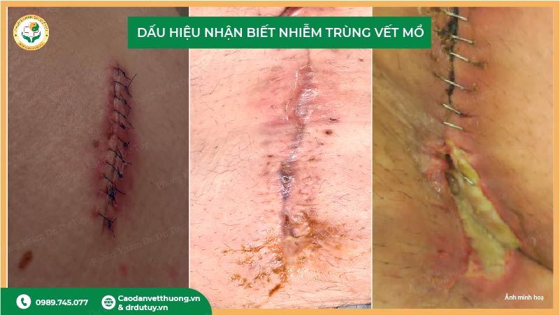 dấu hiệu nhiễm trùng vết mổ