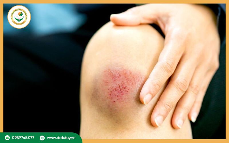 5 dấu hiệu nhiễm trùng vết thương hở cảnh báo nguy hiểm