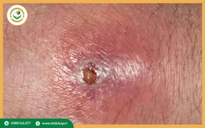 Dịch tiết có mùi hôi và màu lạ (Mưng mủ)