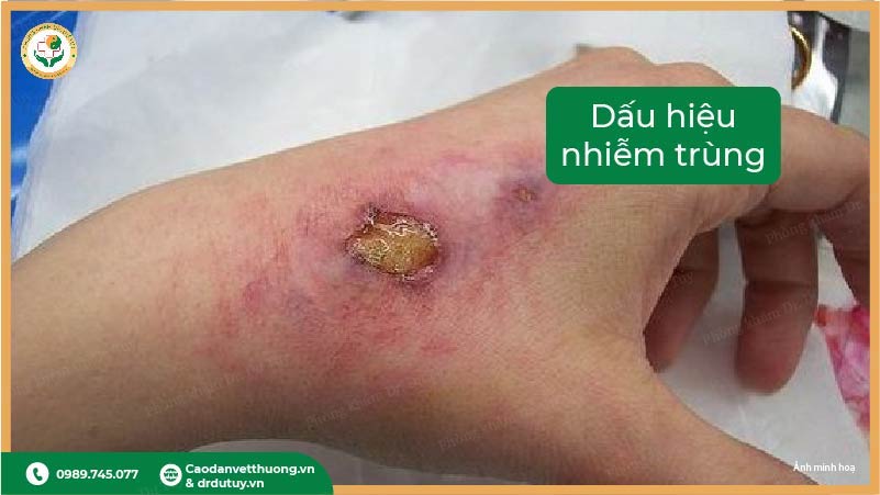 dấu hiệu nhiễm trùng vết thương