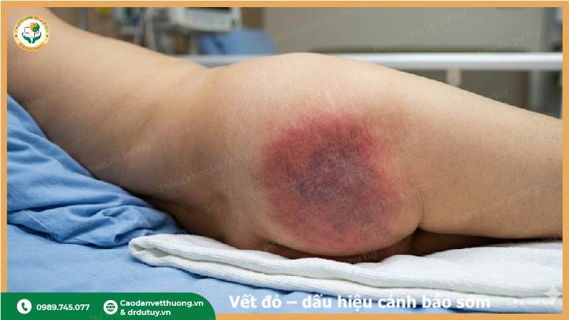 dấu hiệu sớm loét tỳ đè da do kéo dài