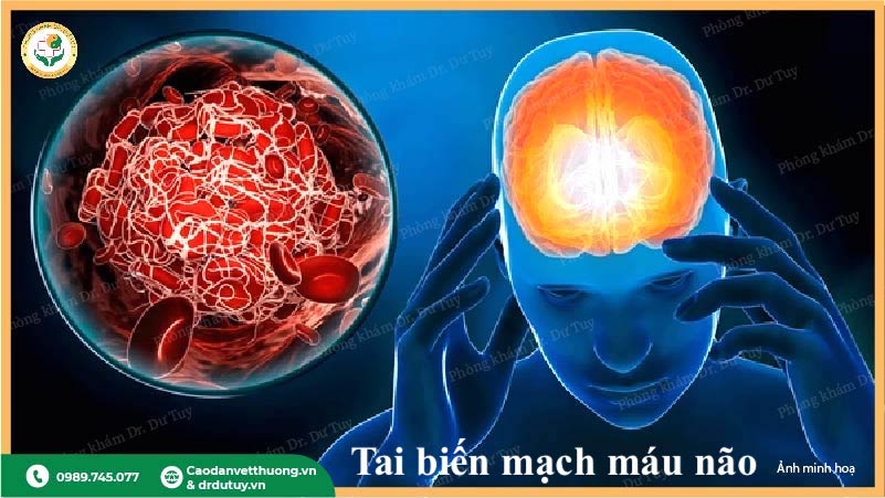 dấu hiệu tai biến mạch máu não ở người cao tuổi
