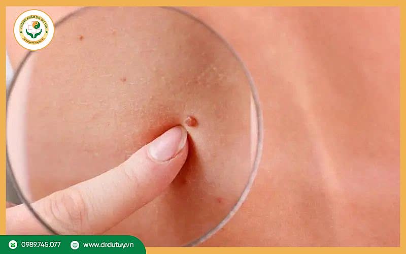 Dấu hiệu ung thư da giai đoạn cuối