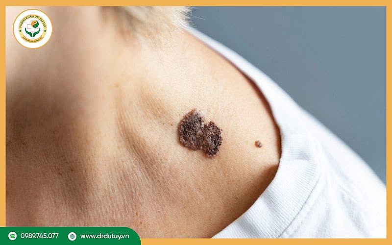 Tổng quan về ung thư da giai đoạn cuối